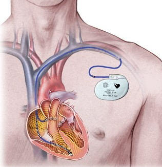 Les défibrillateurs cardiaques à Willems